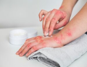 Minor Burn Treatment