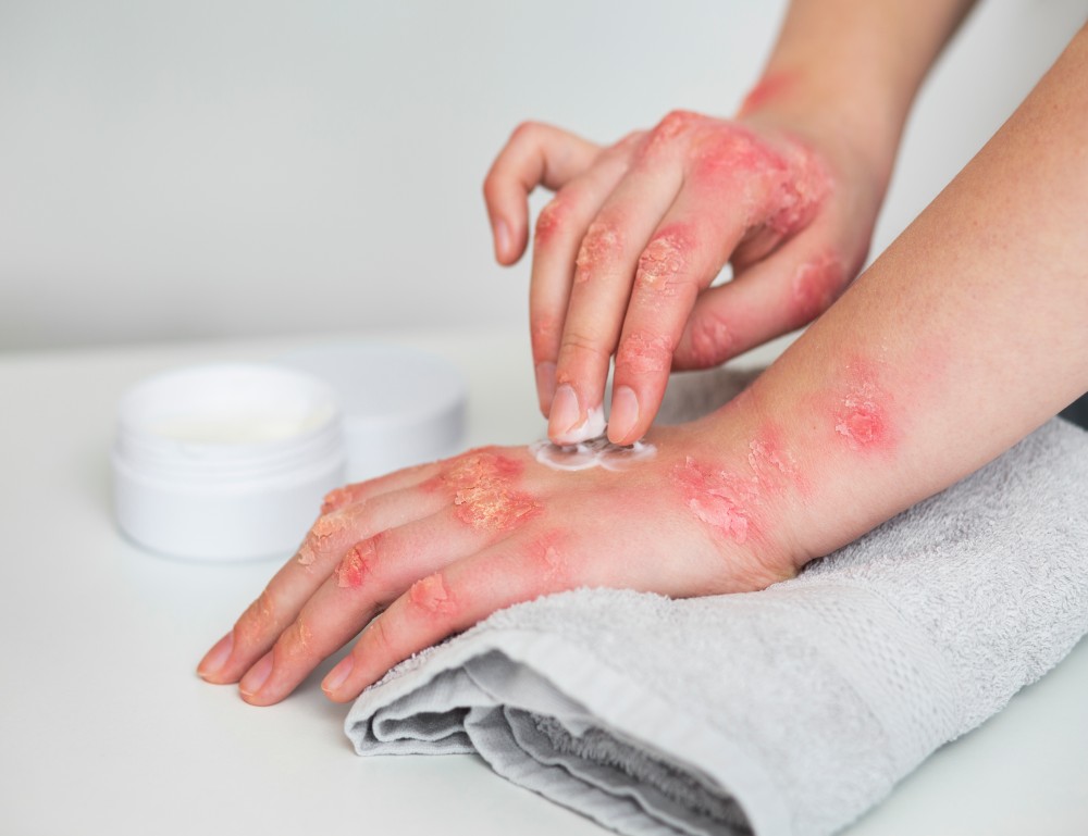 Minor Burn Treatment