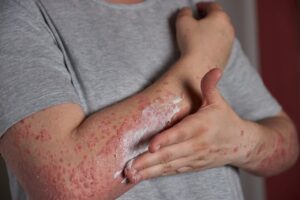 rash treatment Katy TX