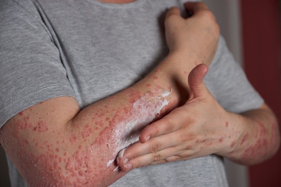 rash treatment Katy TX